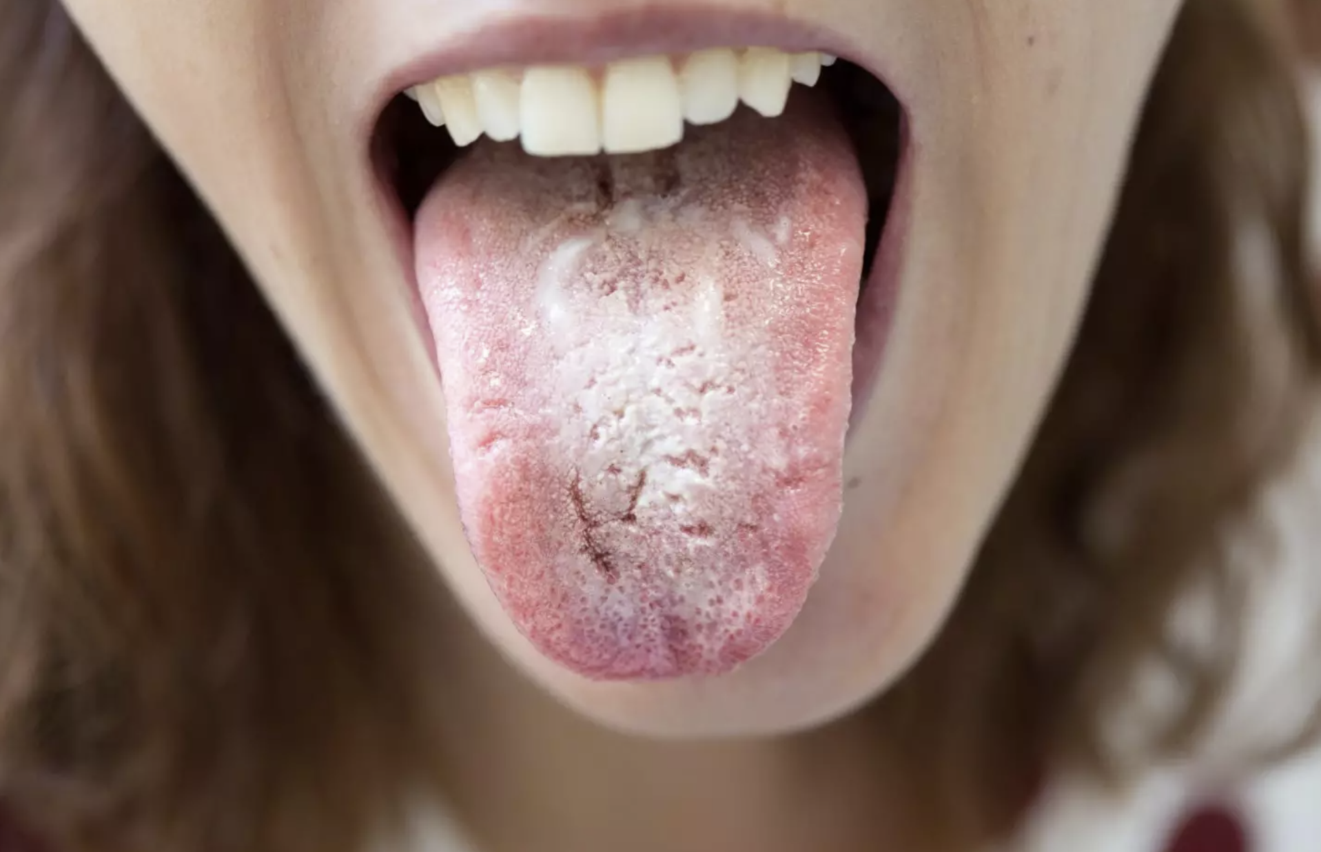 Candida overgrowth — gut fungal imbalance
