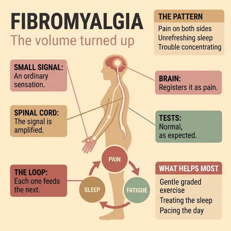 Diagram of pain signalling from body to spinal cord to brain, showing amplified signals in fibromyalgia, alongside the loop connecting poor sleep, fatigue and pain