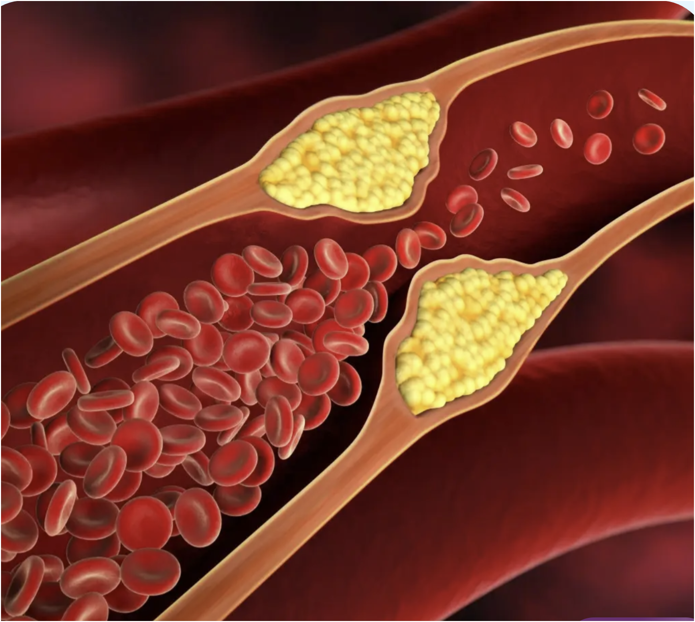 High cholesterol — arterial plaque and LDL buildup