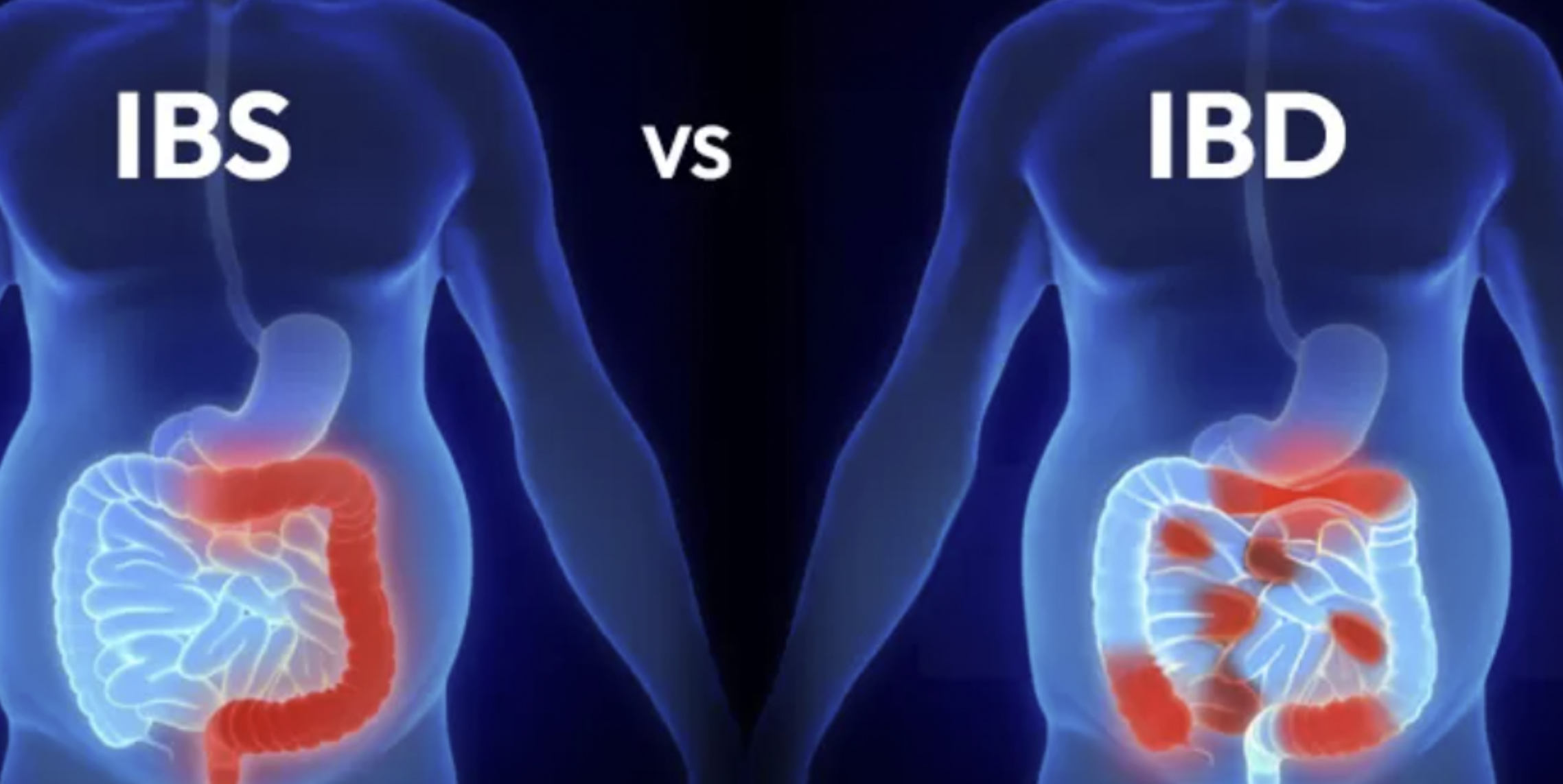 IBS and IBD — gut inflammation and digestive health