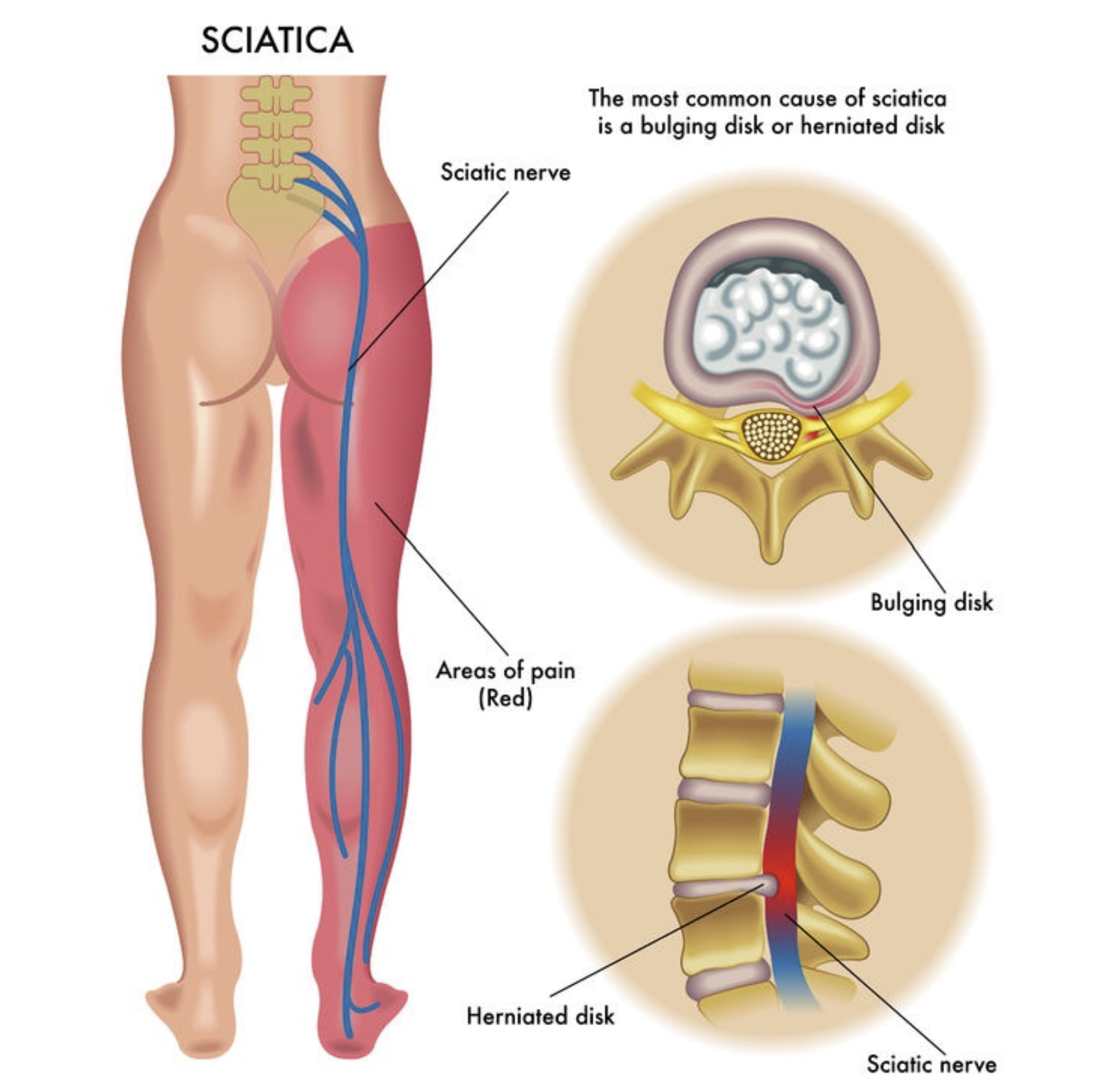Sciatica — lumbar nerve compression and spine health
