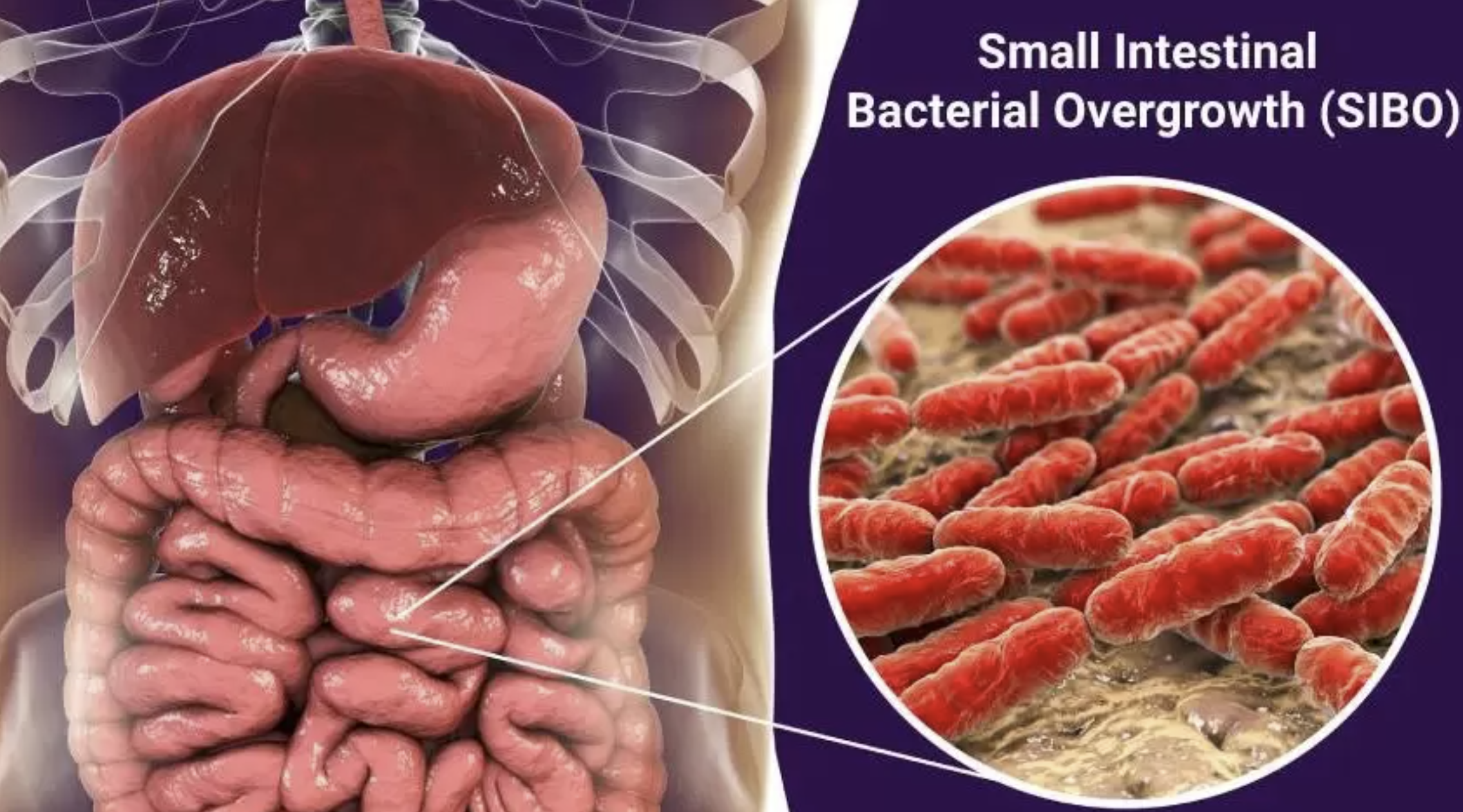 SIBO — small intestinal bacterial overgrowth